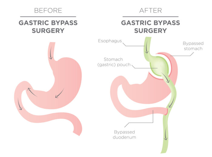 Gastric bypass illustration